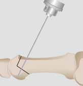 1-1 Place a bone clamp to create the necessary compression across the osteotomy or fusion site (when applicable).