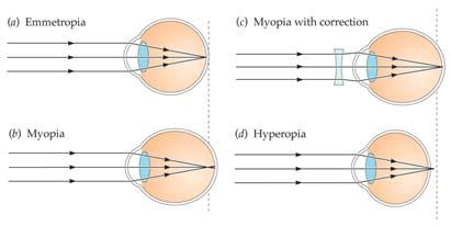 2 Eyes That See Light Problems of Refraction: Myopia: When the light entering the eye is focused in front of