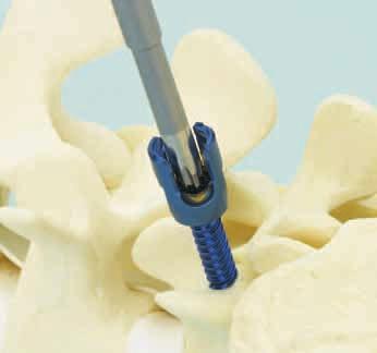 Insert the screw into the prepared pedicle. Repeat for each screw site. Option A: Inserting screw with Stabilizing Sleeve Required instruments 03.620.