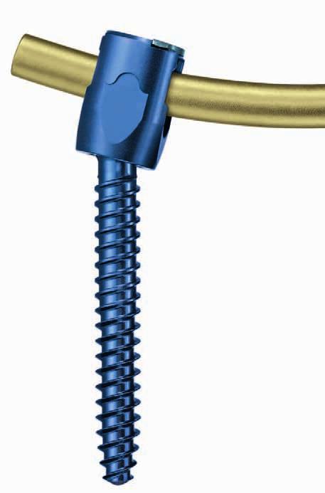 Pangea Degenerative Spine System. Top Loading Preassembled Pedicle Screw System for Posterior Stabilization of the Thoracolumbar Spine.