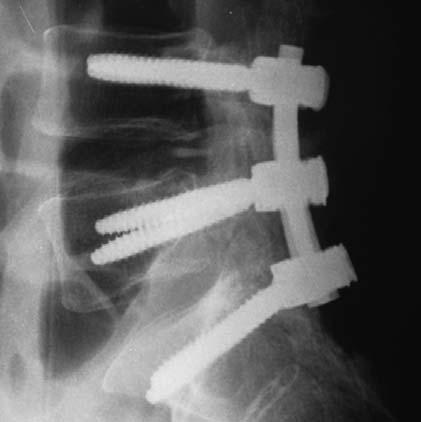 Indications and Contraindications The Pangea Degenerative Spine System is a posterior pedicle screw fixation system (T1 S2) intended to provide precise and segmental stabilization of the spine in