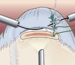 20 The white suture strand is loaded into the eyelet of the Shuttle Relay suture passer outside the anterior cannula.