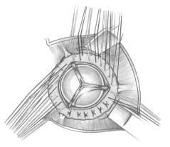 Wire sutures are used on the sternum unless it is fragile, in which case absorbable sutures can be used.