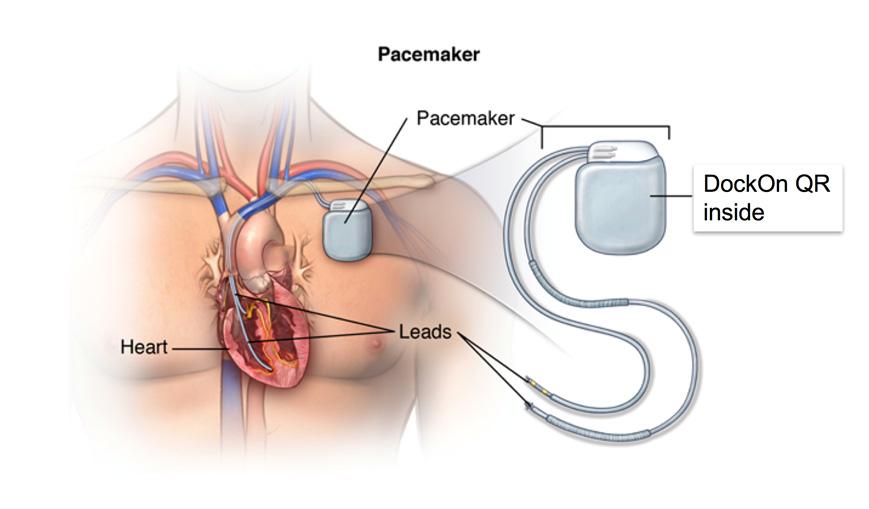 7. Master project/ Internship: design of a low power receiver for pacemaker The Medical Implant Communication Service (MICS) was created in 1999 with a frequency range 402 405MHz which is part of the