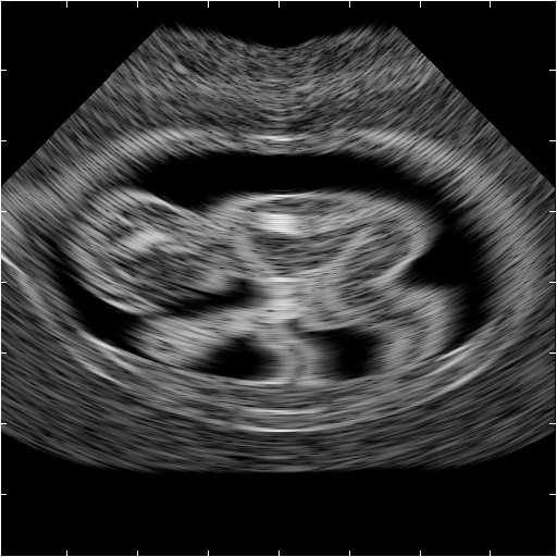 Simulated fetus image Fetus scatter map 0 Figure 4: Simulation of artificial fetus. Fig. 4 shows the fetus. Note how the anatomy can be clearly seen at the level of detail of the scatterer map.