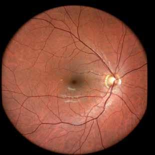 camera Preserved image quality in presence of media opacities such as cataract High resolution images No