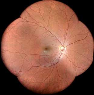 5 mm pupil No optic disc bleaching No saturation of the red channel like in traditional fundus cameras