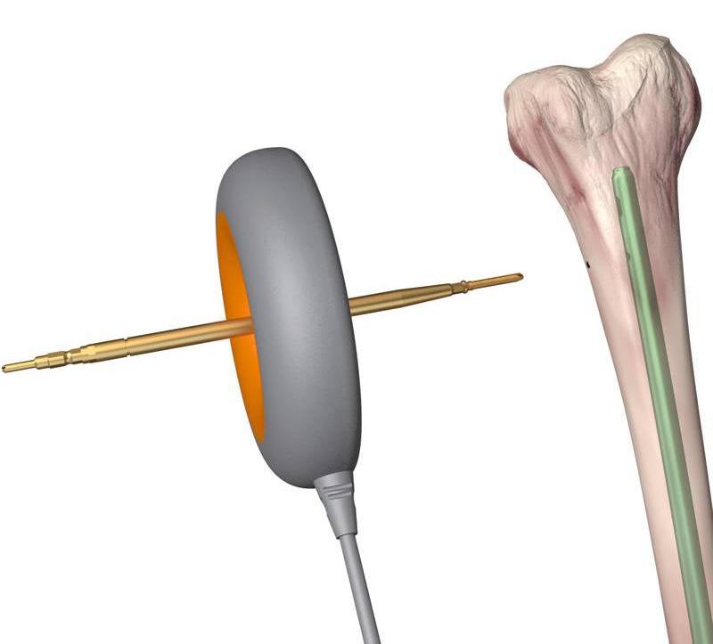Innovation clinical and cost benefits TRIGEN SURESHOT Distal Targeting System A 3-D image system that eliminates the use of fluoroscopy during the placement of distal screws in an intra-medullary