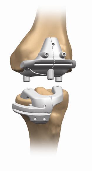 Innovation Being part of the solution VISIONAIRE Patient Matched Instrumentation Patient specific cutting blocks ~10,000 total knee operations conducted using VISIONAIRE to date