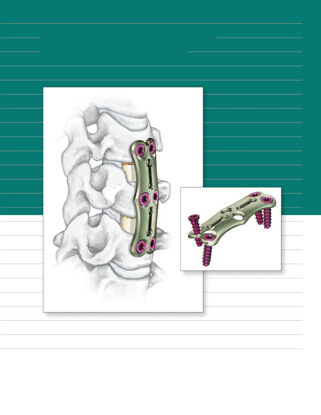 ACLP Anterior Cervical Locking Plate System TECHNIQUE