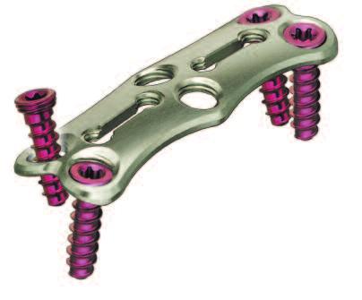 ACLP Anterior Cervical Locking Plate System The ACLP System is designed to reduce the number of surgical steps by incorporating a one-step locking mechanism.