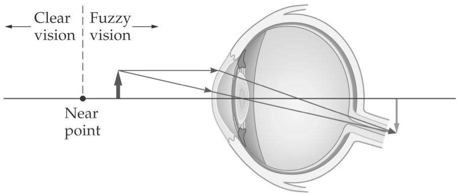 27-2 Corrective Optics & Human Eye A farsighted person: see distant objects clearly but cannot focus on close