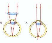 Lenses and focal points The cornea and lens of the eye act as two convex lenses.