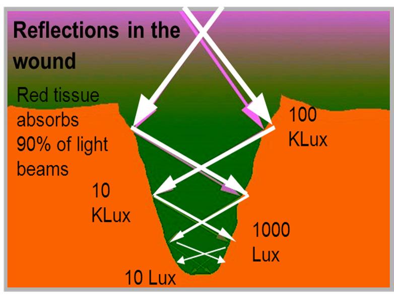 WHAT IS A SURGICAL LIGHT MADE OF? 1. Obviously, the first component of a surgical light is a source that produces light, a lot of light Red tissue absorbs 90% of the emitted light.