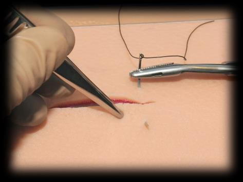 The needle should emerge approximately 5mm away from the edge of the incision.