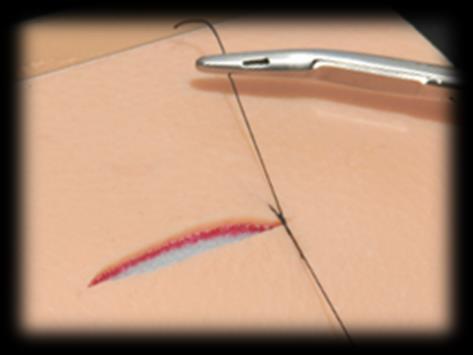 the free end, pull it through the loop and tighten the knot. Cut the ends of the suture material to approximately 1cm.