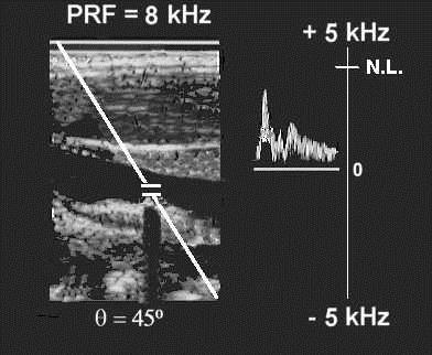 PW - ALIASING Example: The PRF is 8 khz, the Nyquist Limit is 4 khz. The Doppler shift does not exceed the Nyquist Limit.