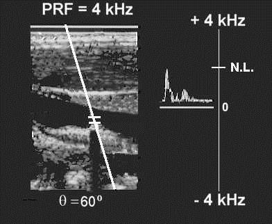 PW - ALIASING Example: The PRF is still 4 khz, the Nyquist Limit is still 2 khz.