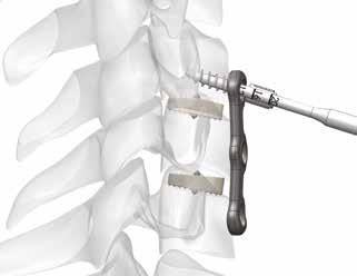 WARNING In case of sclerotic bone or any other reason that can cause high resistance during screw placement, bone preparation should be performed by using the provided tap. 29.