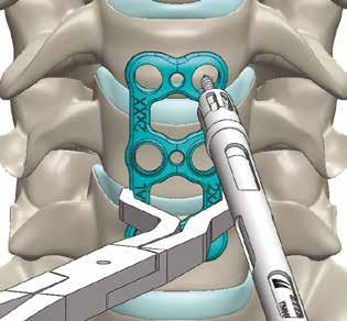 The Fork Drilling Guide perfectly fit with the several Mecta-C cervical implants providing a dedicated tool for the cervical