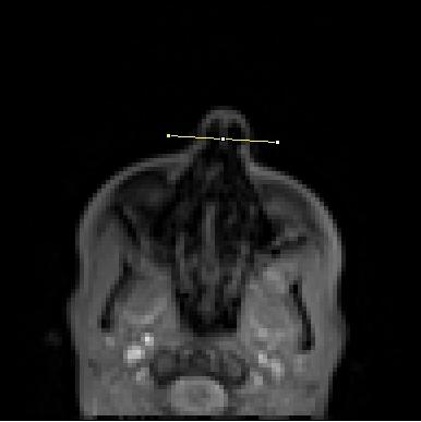 Alae Tracker: Tracking of the Nasal Walls in MR-Imaging 3 Fig. 1.
