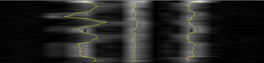 Alae Tracker: Tracking of the Nasal Walls in MR-Imaging 5 Fig. 3. The result of the reslicing (background) and the estimation process (yellow lines). Table 1. RMSE with respect to manual segmentation.