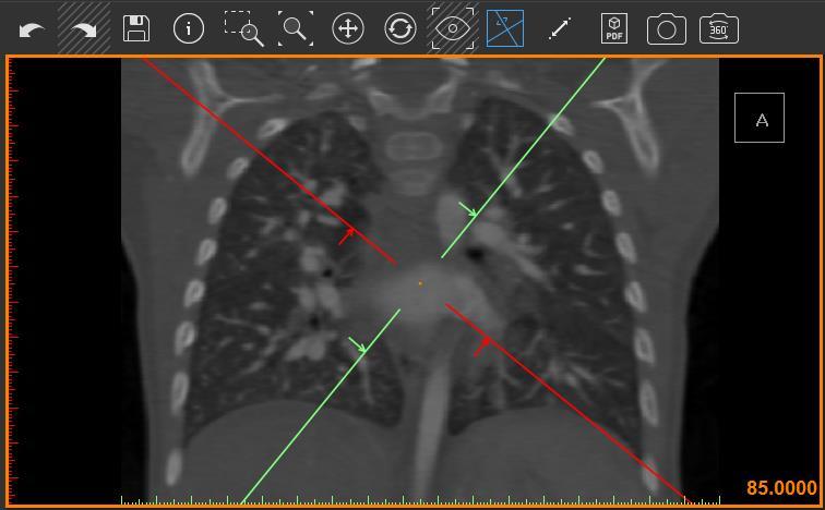 Release notes 11/2017 L-10740 Revision 3 For Mimics inprint 3.0 6 2.3. Multi Planar Reconstruction (MPR) With the Multi Planar Reconstruction tool images can be interactively resliced to visualize certain areas of the anatomy.