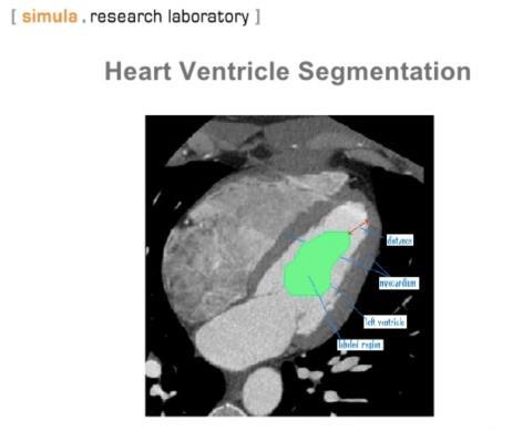 REAL-LIFE EXAMPLES OF AI IN Cardiology & Radiology Left ventricle segmentation from CT stacks