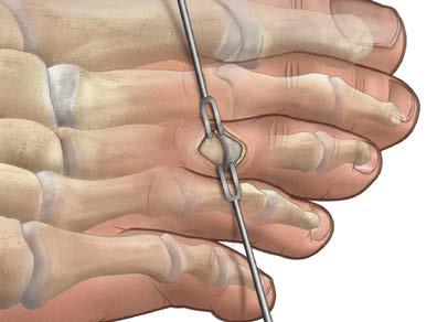 Acumed Acutrak Headless Compression Screw System Surgical Technique Hammertoe Fusion Set Surgical Technique 1A transverse incision is made centered over the proximal interphalangeal (PIP) joint.