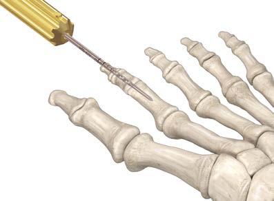 First insert the hand drill retrograde into the proximal phalanx. Care should be taken to ensure that the reamer stays in the intramedullary canal and does not break the cortex.