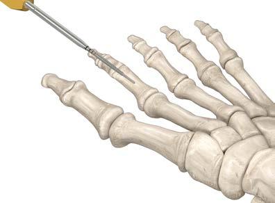 Acumed Acutrak Headless Compression Screw System Surgical Technique 4Screw insertion: Once the appropriate screw size is determined, the drill is removed and the screw is inserted.