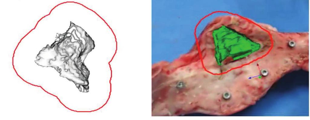 a b Fig. 4. Proposed AR system for bone tumor resection surgery; (a) resection margin of 3D tumor model and (b) captured scene from the proposed AR system. Fig. 5.