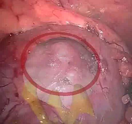 surgery Retinal microsurgery system