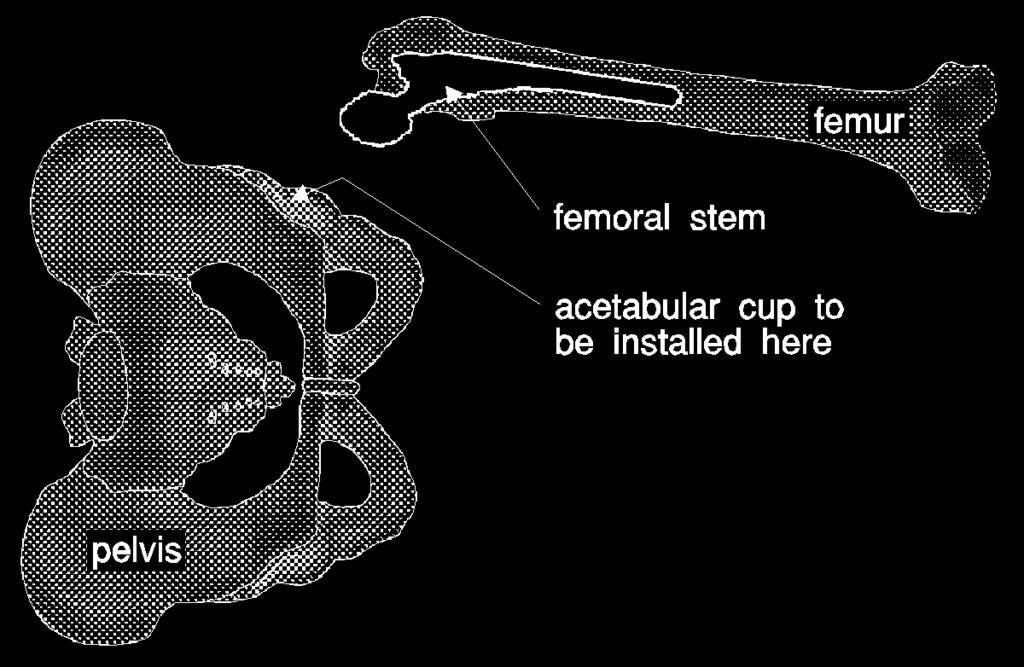 Surgical CAD/CAM: ROBODOC System