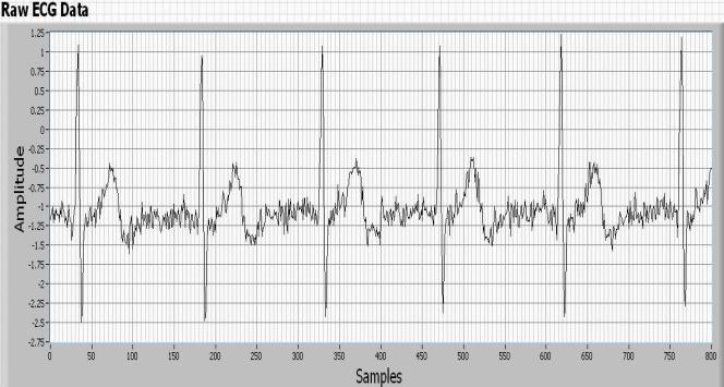 Figure 6 ECG signal applying a Biortogonal - UWT filter Figure 3 Original ECG signal Figure 7 shows the