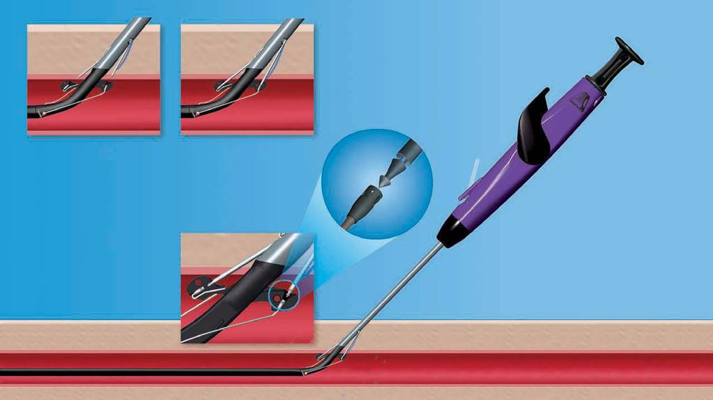 NEEDLE DEPLOYMENT Needles Needles Needle Plunger a Foot Link b Foot Link Needle Tip Marker Lumen Collar Cuff Foot While maintaining a 45º angle, and stabilizing the device with