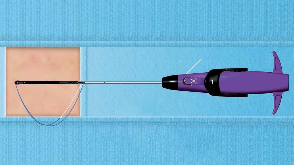 SUTURE PRESENTATION Guide Wire Exit Port Deliberately withdraw the until the guide wire exit port is at skin level.