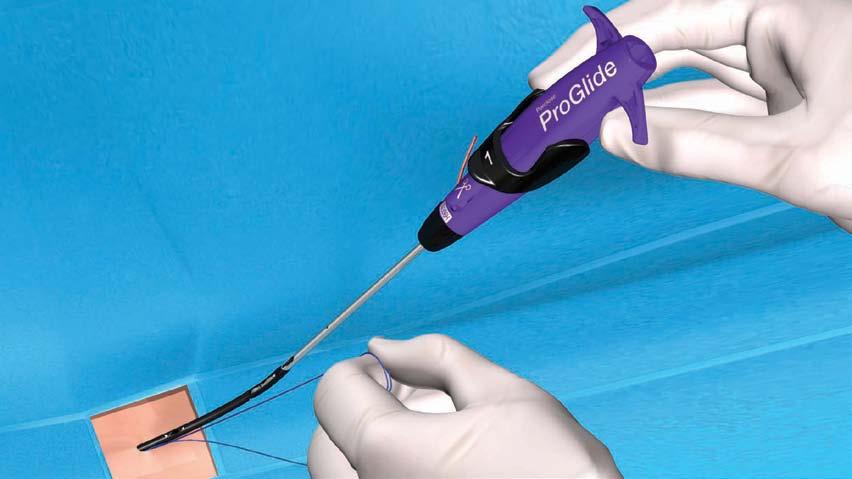 KNOT MANAGEMENT Double-Load Technique Keeping the suture coaxial to the tissue tract, withdraw the device with the right hand while maintaining tension on the rail suture with