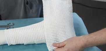 Take the distal part of the splint from the water bath and remove excess water.