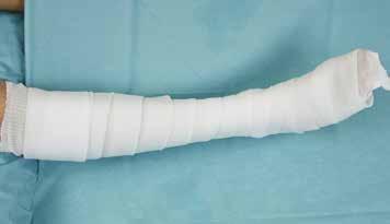 X -LITE CLASSIC Short Leg Cast with an Optional Posterior Reinforcement Splint. Materials: Stockinette in appropriate width 7 cm 10 cm.