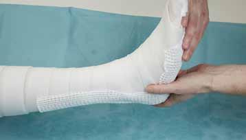 Apply the posterior splint. Start casting your patient at the distal end of the foot 1-2 cm below the padding.