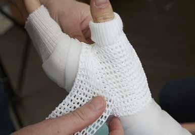 Making a splint or a cast Start with stockinette and undercover padding to protect the patient s skin before applying the X-LITE material.