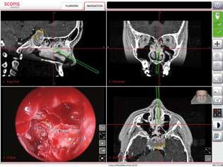 Scopis Navigation in use in CMF surgery With the unique combination of both measurement