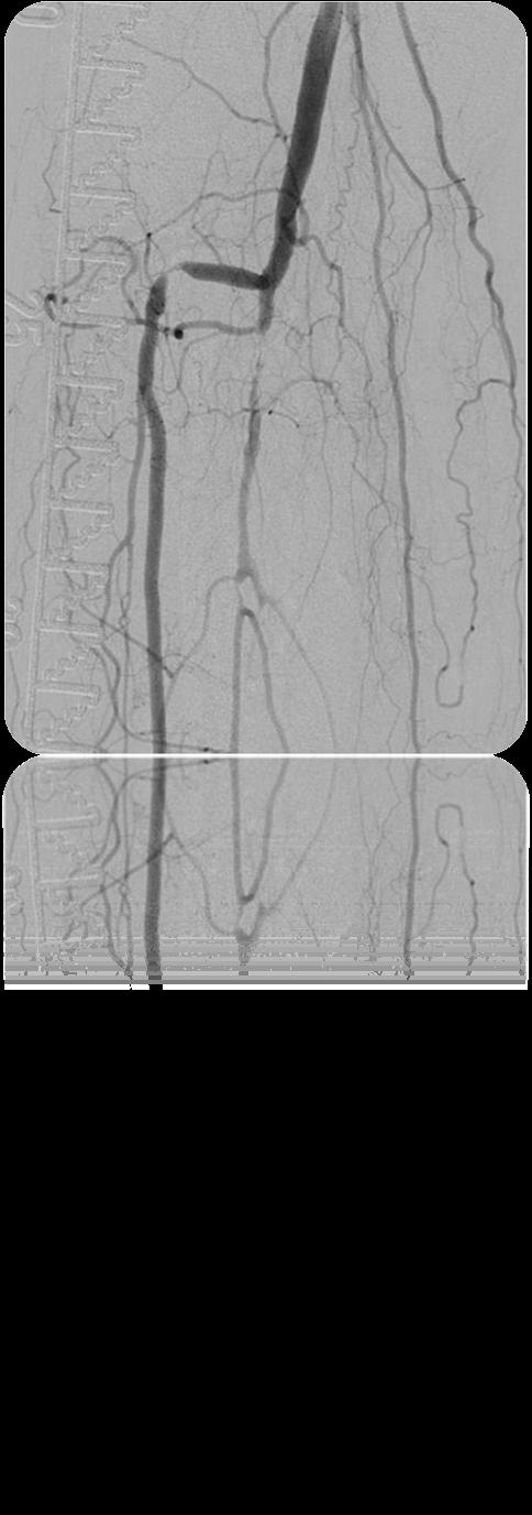 Guide Wire Usage Access lesions Cross lesions Facilitate delivery of interventional devices Why is this important?