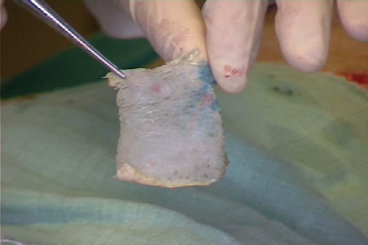 .. Micro-Motor Two steps: skin harvesting grafting of the harvested skin strip onto a burnt location Cutting
