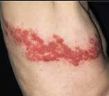 IT can FEEL as bad as it LOOKS. Here are some photos of the Shingles rash, which can take up to 30 days to heal.