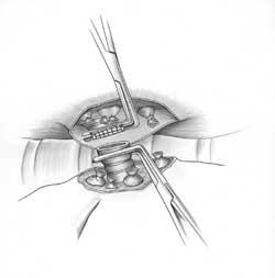 Closure is usually achieved with mechanical devices, particularly staples.
