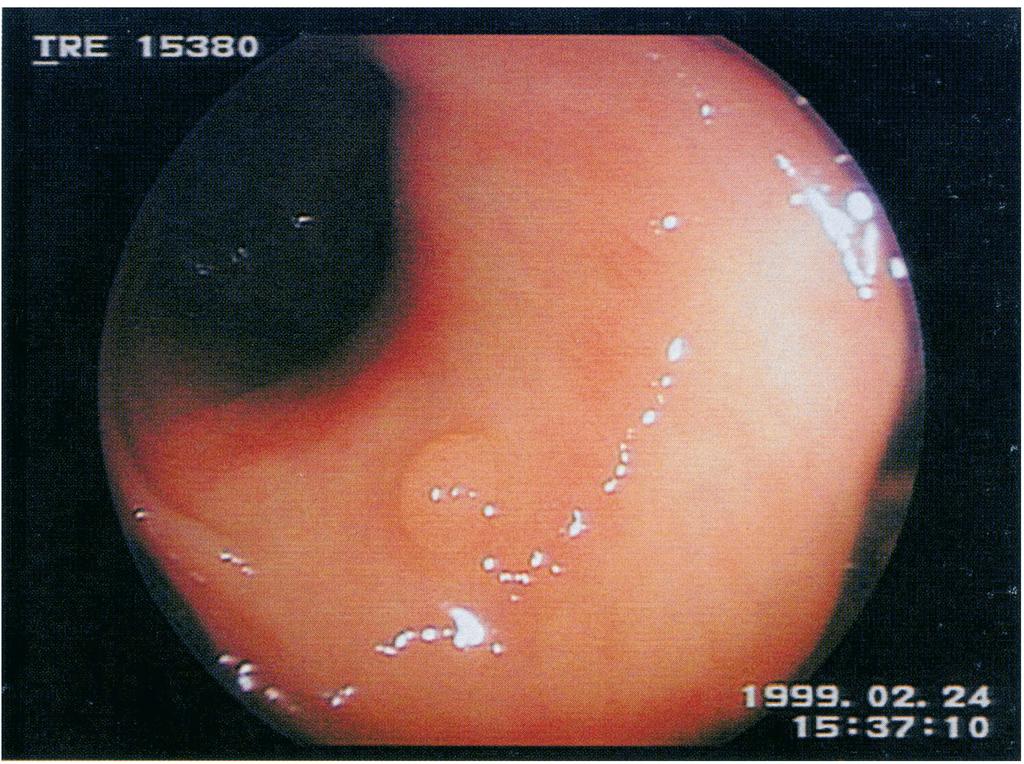 MAGNIFIED EXAM OF COLORECTAL POLYPS 79 FIGURE An endoscopic image of a small, 2.5 mm polyp in the transverse colon examined at normal magnification. circular, or oval pit patterns were observed.