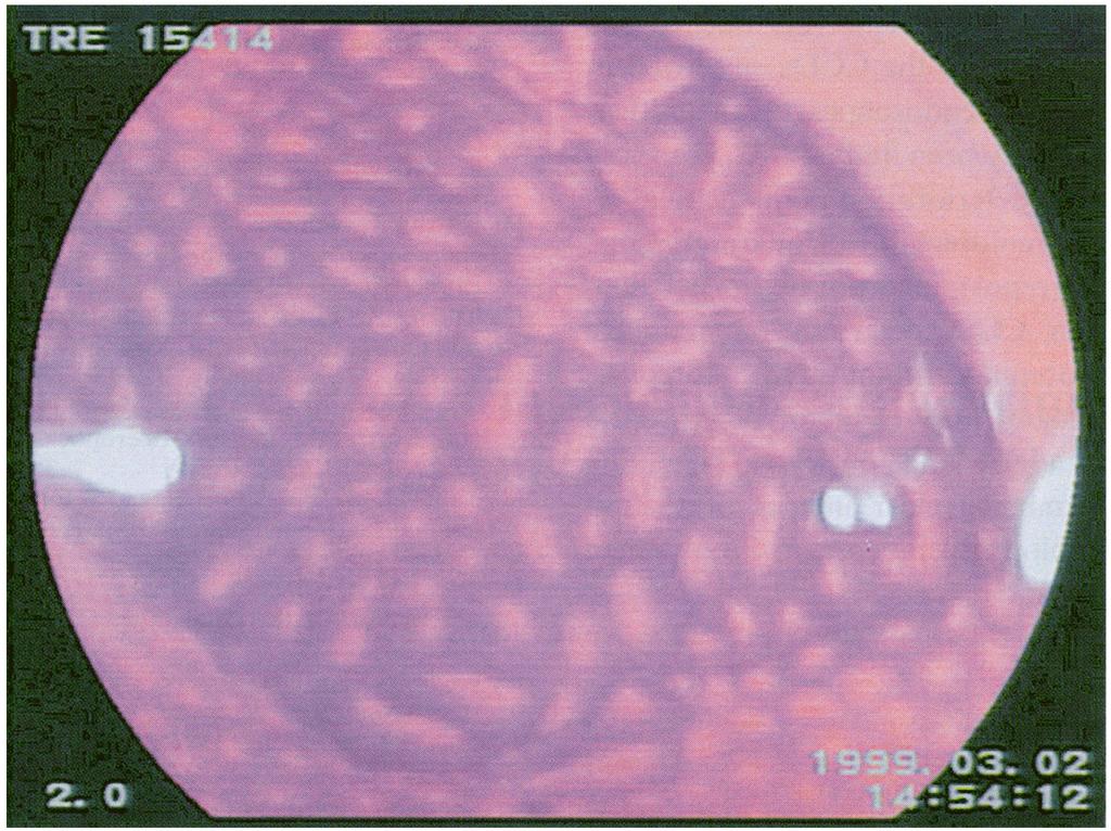 MAGNIFIED EXAM OF COLORECTAL POLYPS 81 FIGURE 4 After the lesion was dyed twice using crystal violet, a tubular and oval pit pattern with a regular arrangement was observed by optical magnification