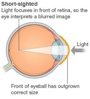 If the ability to adjust the curvature of the lens is weakened, a person may suffer from either of the following problems.